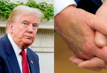 Los moretones en la mano de Trump