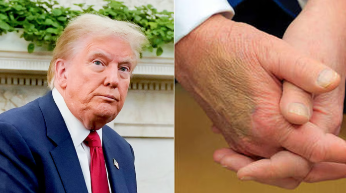 Los moretones en la mano de Trump